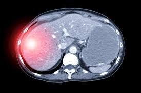 Get Oriented with Liver Cysts download 4 - Get Oriented with Liver Cysts